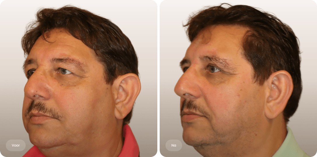 Voor en na foto van bovenooglidcorrectie bij een man voor een open blik en minder hangende oogleden bij The Body Clinic