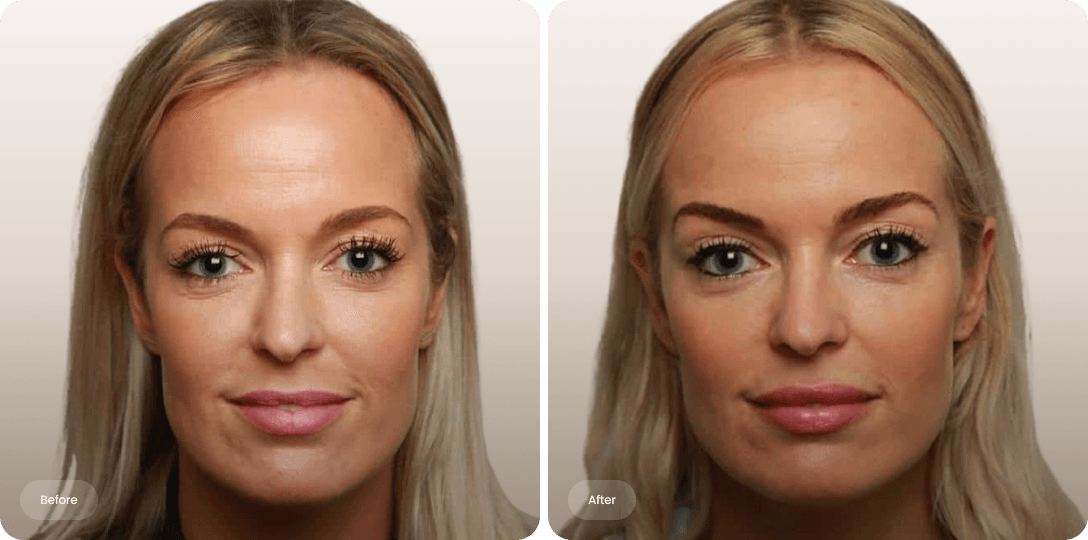 Visibly lifted upper eyelids after a Plexr treatment for a more open, refreshed eye appearance without surgery.