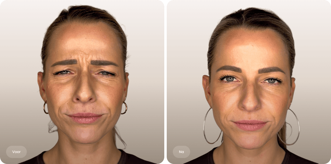 Voor en na foto van botoxbehandeling fronsrimpel bij een vrouw voor een ontspannen uitstraling bij The Body Clinic