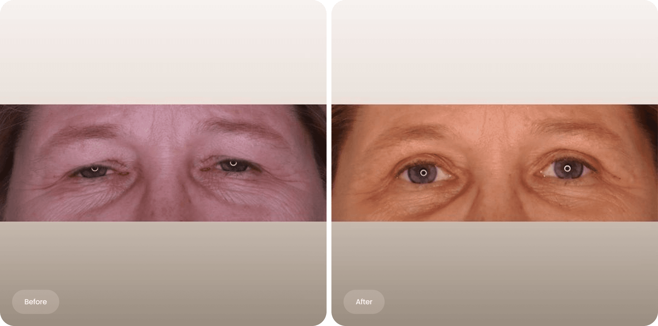 Before and after photo of an upper eyelid correction at The Body Clinic