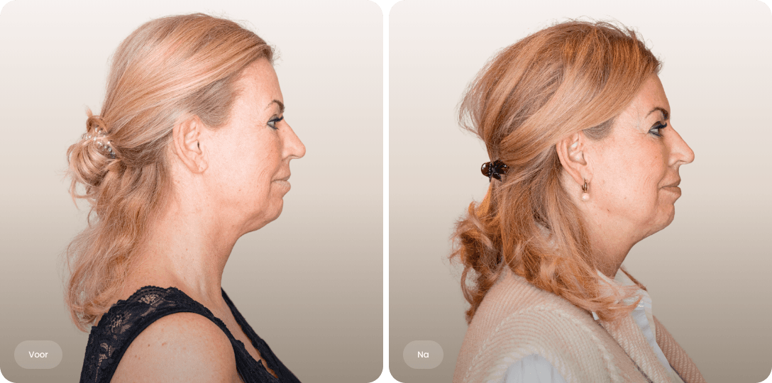 Voor en na foto van NeckTite-behandeling voor een verjongende halslijn en strakker profiel bij The Body Clinic