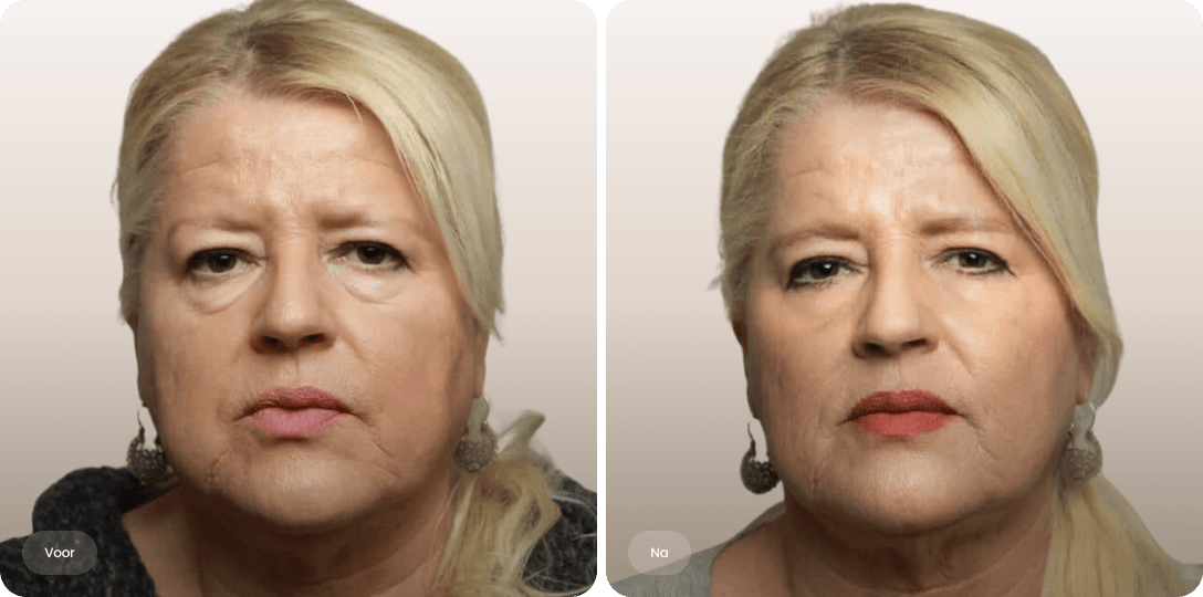 Voor en na foto van Plexr ooglidcorrectie bij een vrouw voor minder hangende oogleden bij The Body Clinic