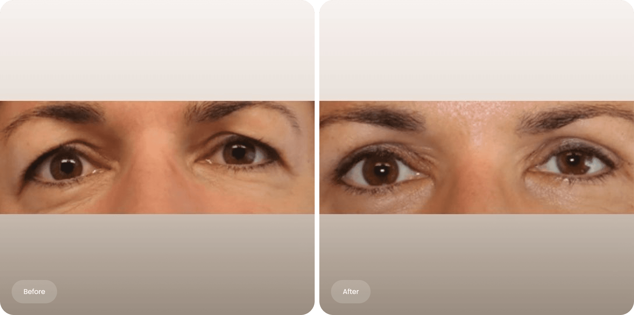 Before and after photo of an upper eyelid correction at The Body Clinic