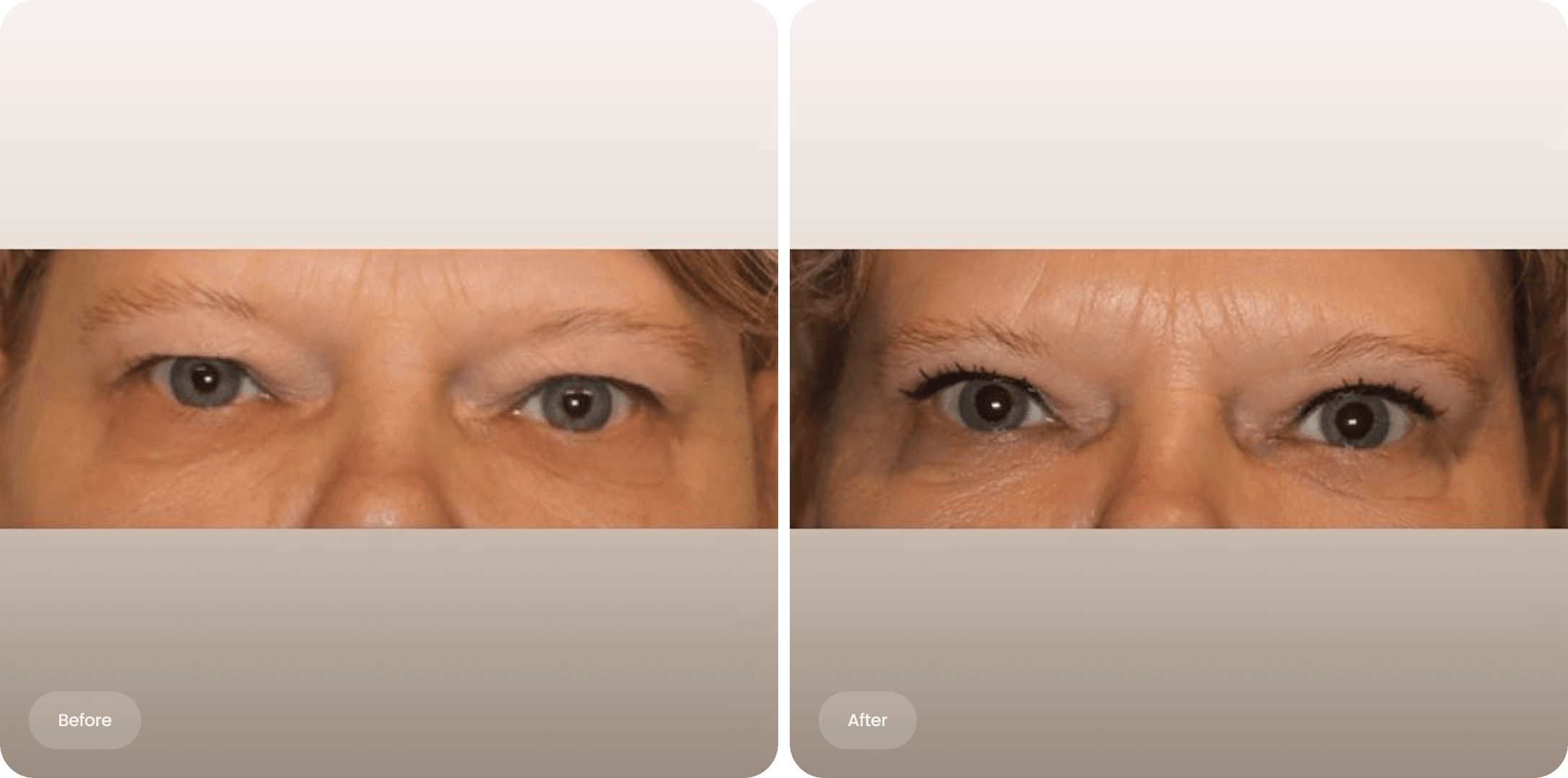Before and after photo of an upper eyelid correction at The Body Clinic