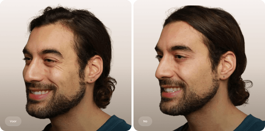 Voor en na foto van botoxbehandeling kraaienpootjes bij een man voor zachtere ooglijntjes bij The Body Clinic