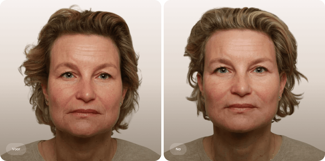 Voor en na foto van fillerbehandeling mondhoeken bij een vrouw voor een vriendelijker en frisser aanzicht bij The Body Clinic