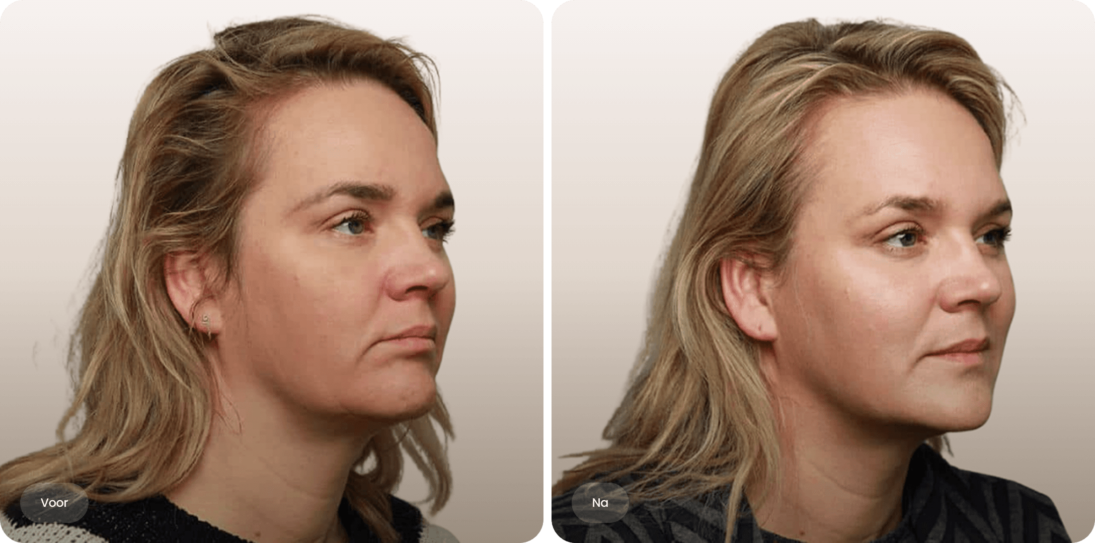 Voor en na foto van fillerbehandeling kaaklijn voor een scherper profiel bij The Body Clinic