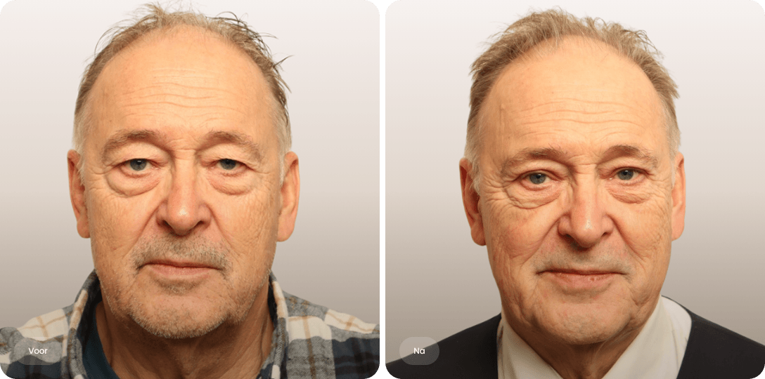 Voor en na foto van ooglidcorrectie bij een man voor een frissere oogpartij en open blik bij The Body Clinic