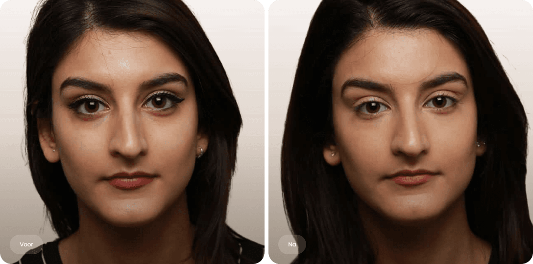 Voor en na foto van fillerbehandeling wallen en traangoot voor minder donkere kringen bij The Body Clinic