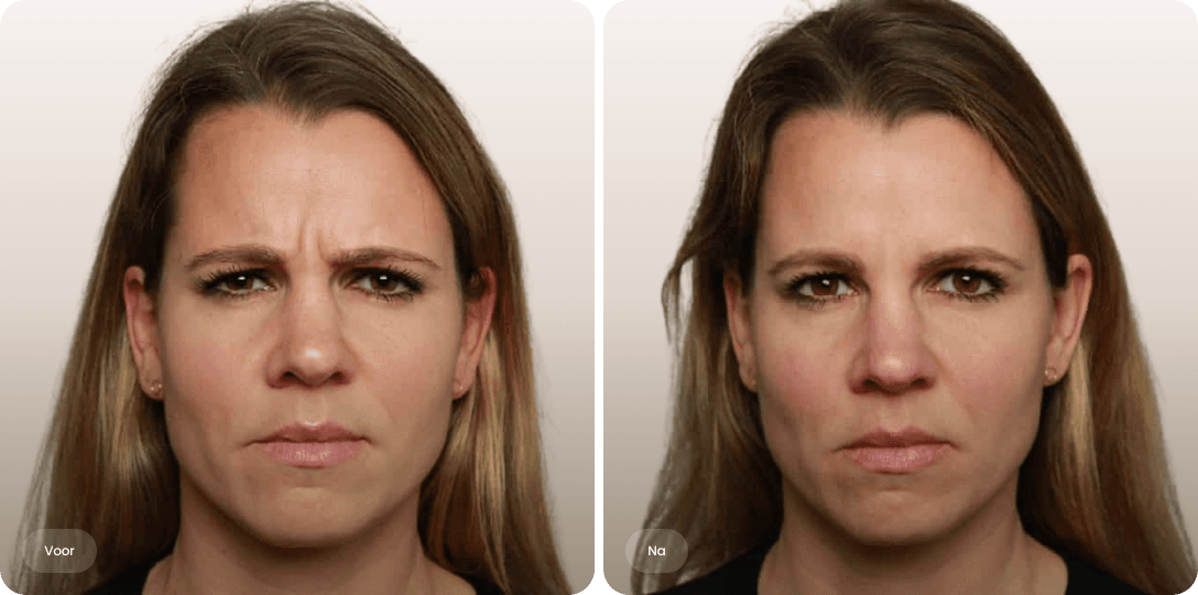 Before and after comparison of a woman's faVoor en na foto van botoxbehandeling fronsrimpel voor een gladder voorhoofd bij The Body Clinicce showing reduced frown lines between eyebrows.