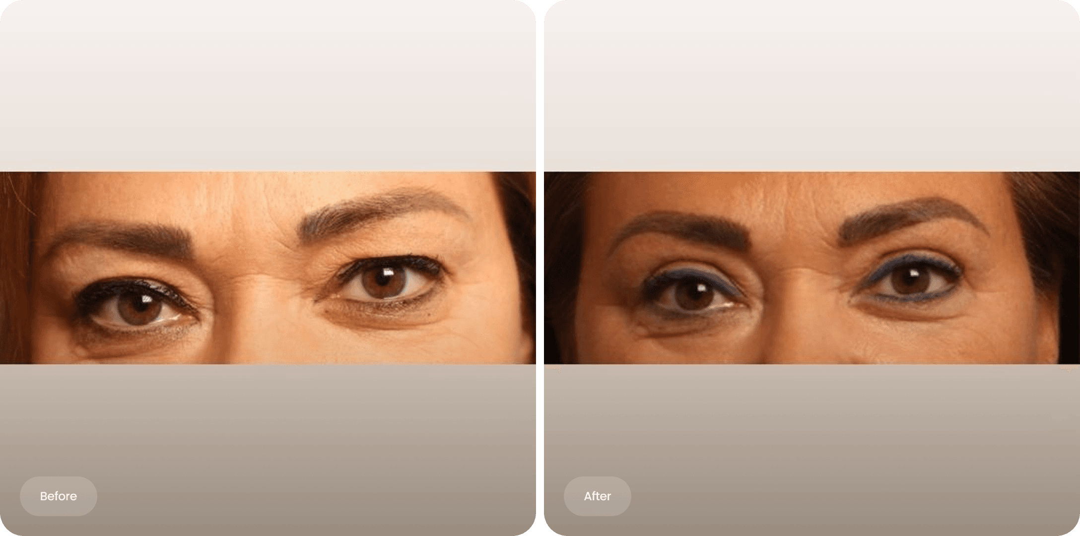 Before and after photo of an upper eyelid correction at The Body Clinic