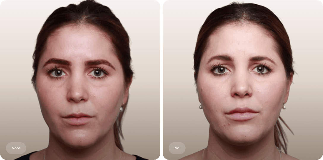 Voor en na foto van fillerbehandeling lippen bij een vrouw voor mooi gedefinieerde en vollere lippen bij The Body Clinic