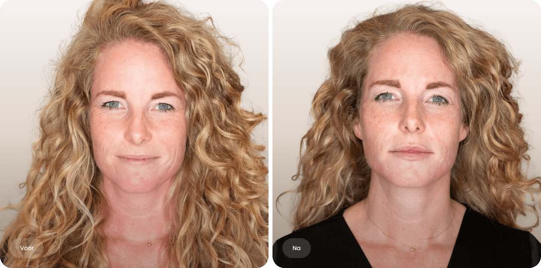 Voor en na foto van liquid facelift met fillers bij een vrouw voor zachtere gezichtslijnen en een frisse uitstraling bij The Body Clinic