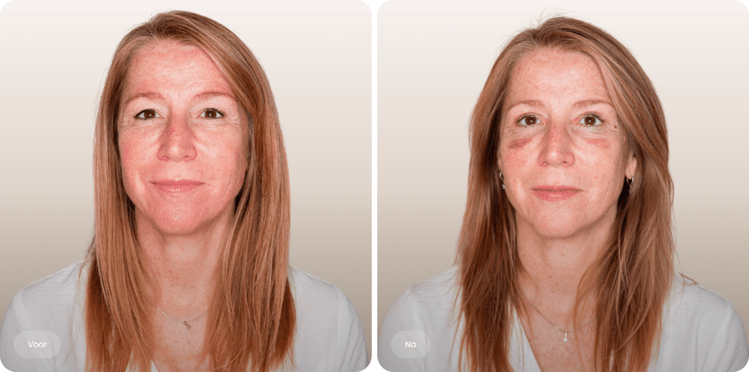 Voor en na foto van ooglidcorrectie bij een vrouw voor minder hangende oogleden bij The Body Clinic