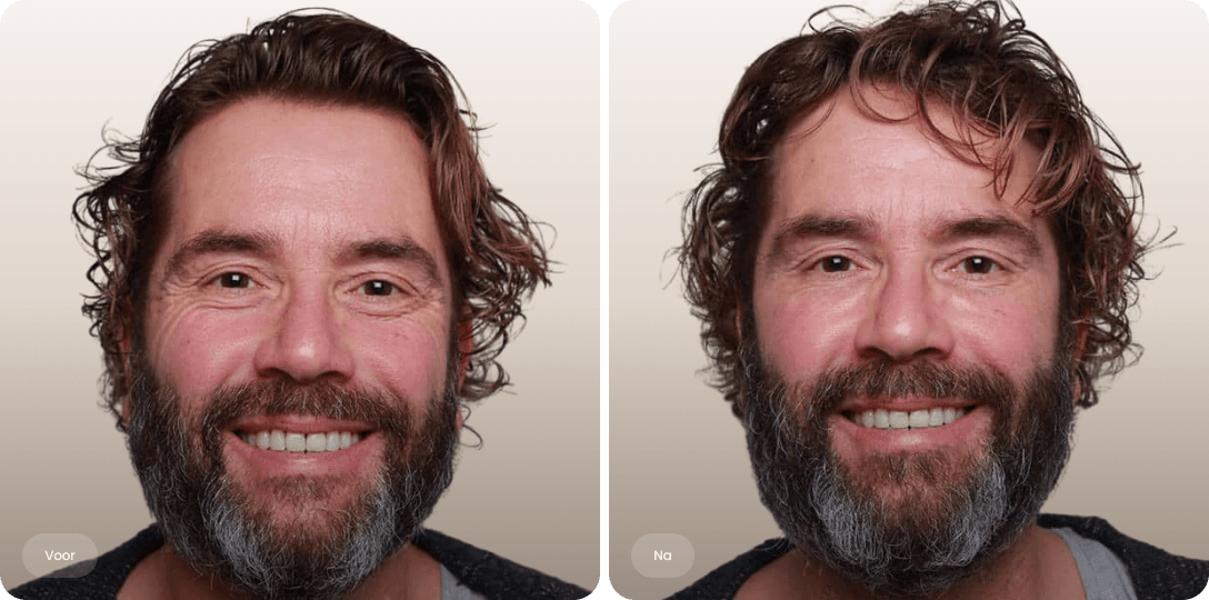 Voor en na foto van botoxbehandeling kraaienpootjes bij een man voor een frissere blik bij The Body Clinic