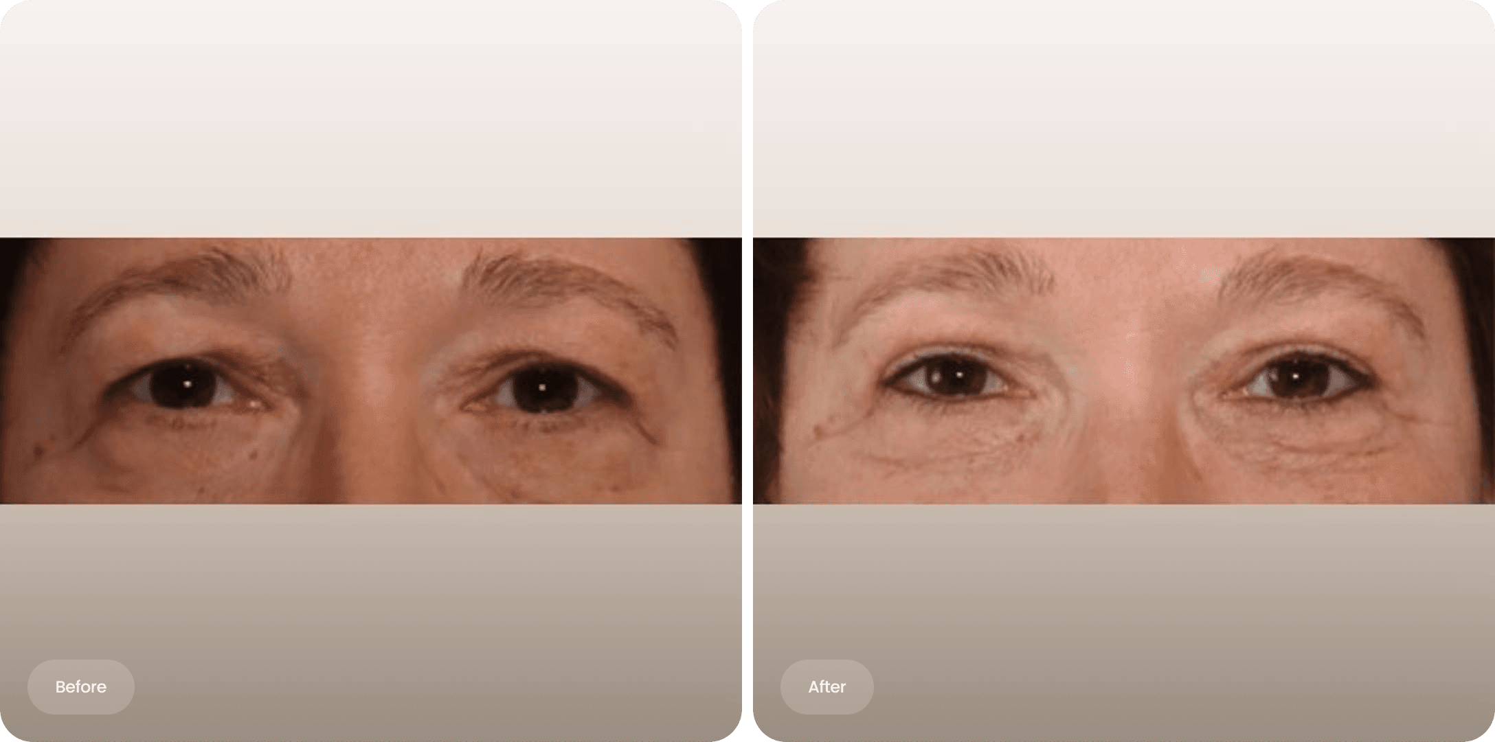 Before and after photo of an upper eyelid correction at The Body Clinic