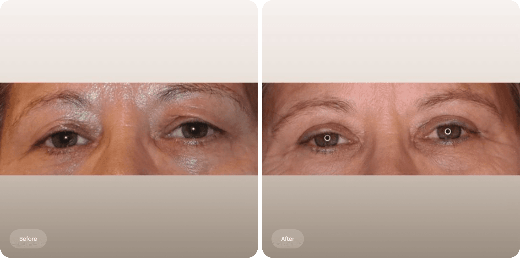 Before and after photo of an upper eyelid correction at The Body Clinic
