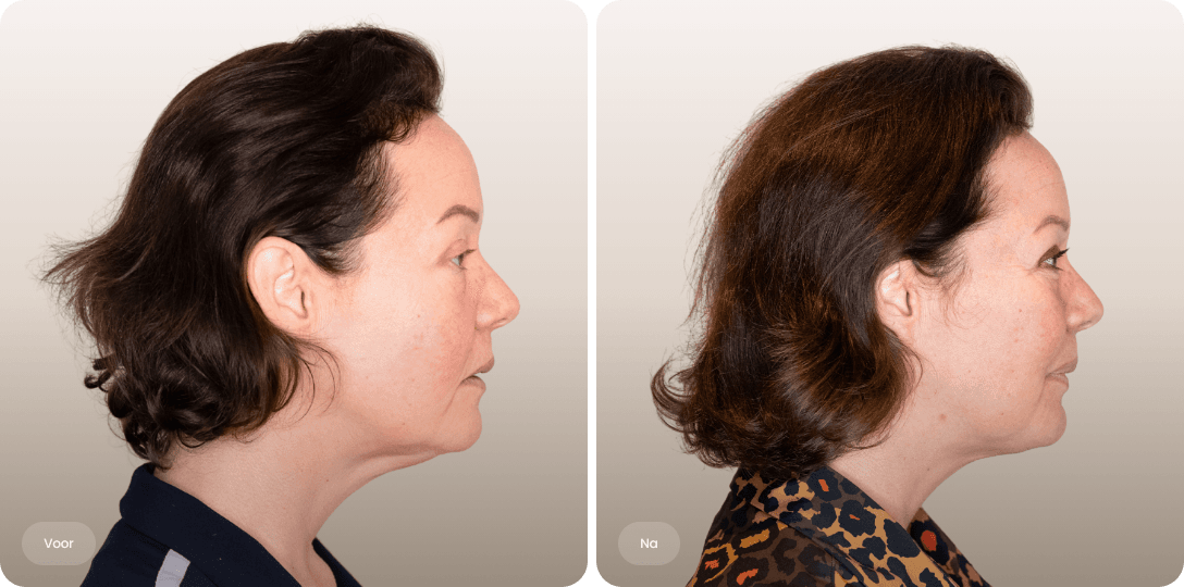 Voor en na foto van NeckTite-behandeling voor een strakkere hals en gedefinieerde kaaklijn bij The Body Clinic