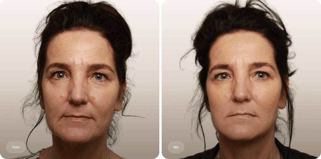 Voor en na foto van fillerbehandeling mondhoeken voor opgetilde mondhoeken en een frissere uitstraling bij The Body Clinic