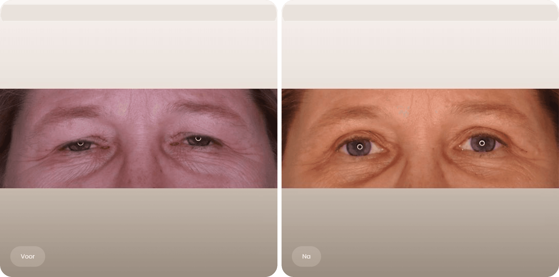 Voor en na foto van een bovenooglidcorrectie bij The Body Clinic