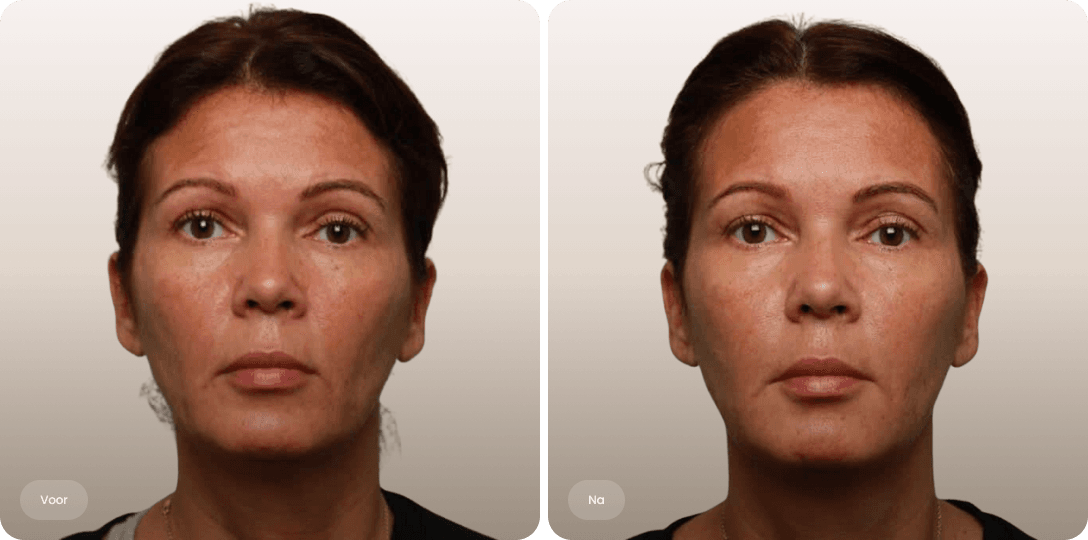 Voor en na foto van liquid facelift met fillers voor een frisse en uitgeruste uitstraling bij The Body Clinic