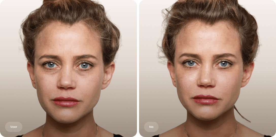 Voor en na foto van fillerbehandeling traangoot en wallen voor een uitgeruste oogopslag bij The Body Clinic