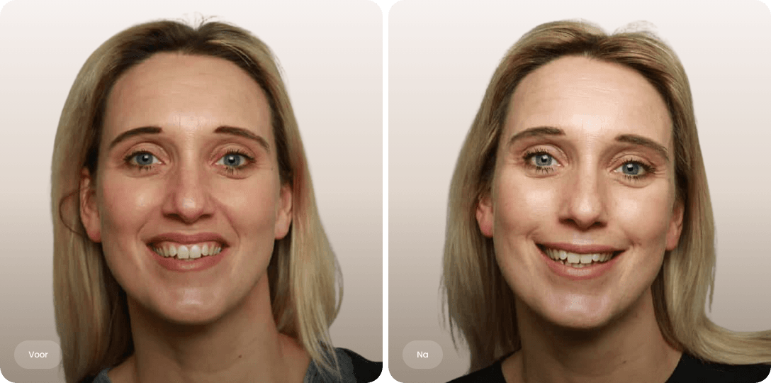 Voor en na foto van botoxbehandeling gummy smile bij een vrouw voor een evenwichtige lach bij The Body Clinic