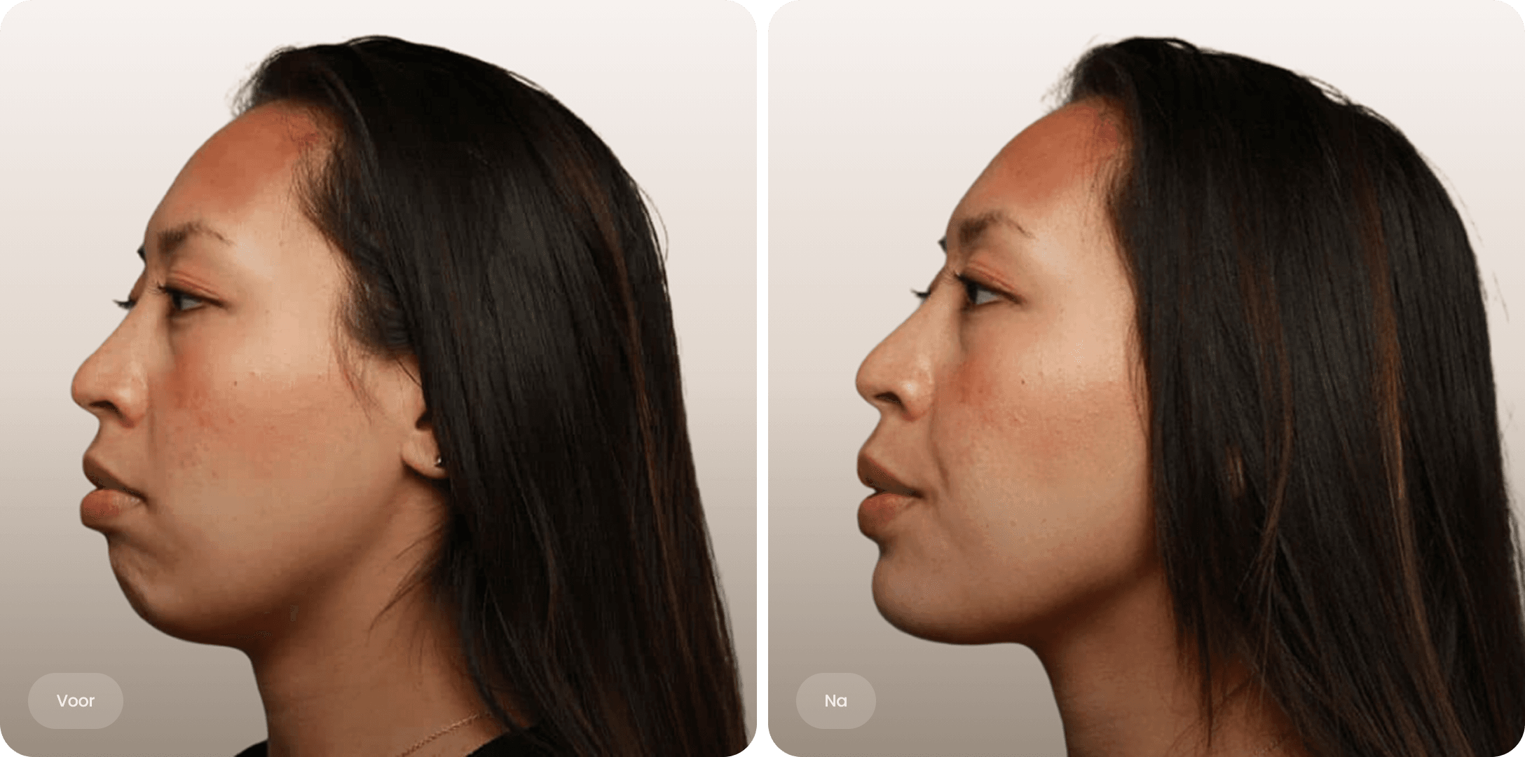 Side profile before and after comparison of an Asian woman's chin and neck area.