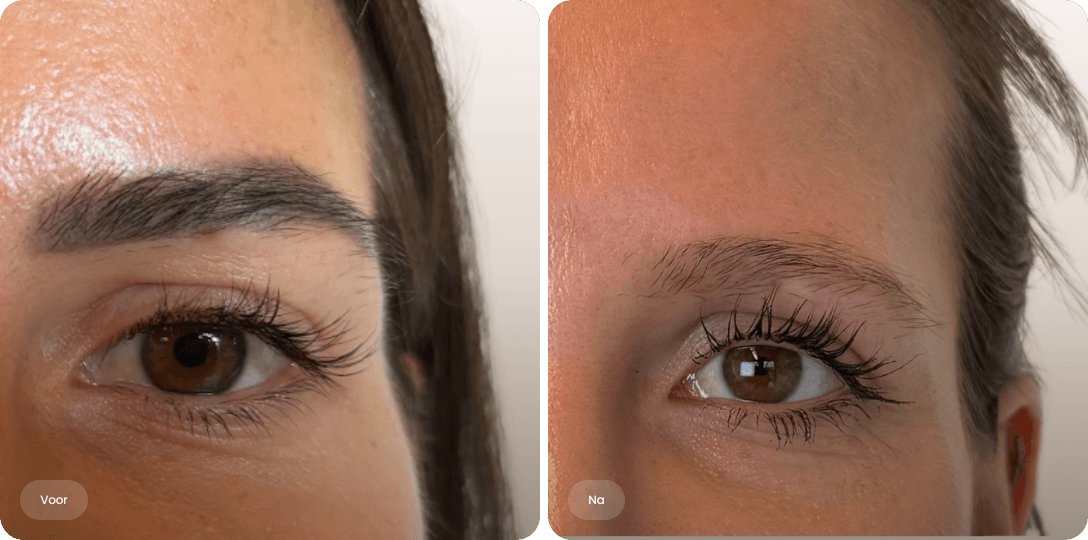 Voor en na foto van PMU verwijderen met laser voor een natuurlijke wenkbrauw bij The Body Clinic