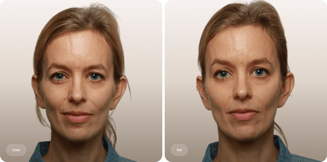 Voor en na foto van fillerbehandeling slapen bij een vrouw voor een evenwichtiger bovengezicht bij The Body Clinic