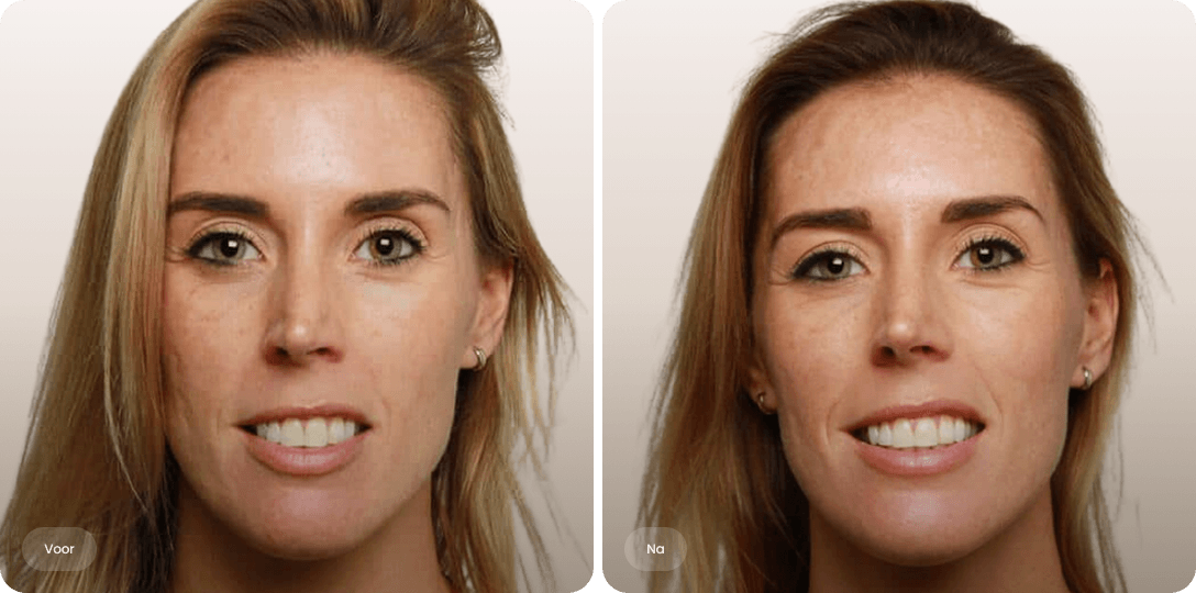 Voor en na foto van fillerbehandeling tegen acnelittekens in het gezicht bij The Body Clinic