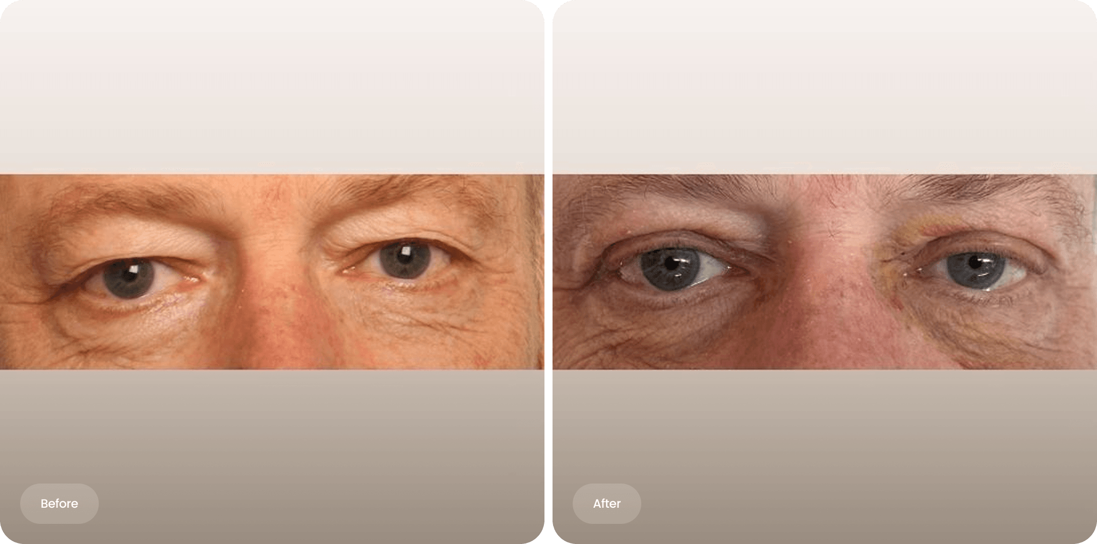 Before and after photo of an upper eyelid correction at The Body Clinic