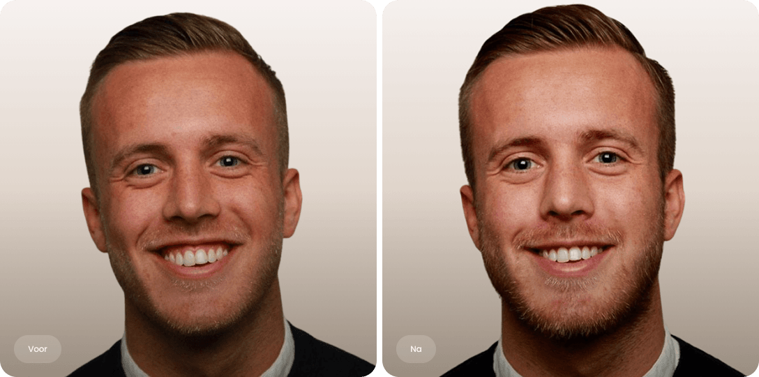 Voor en na foto van botoxbehandeling gummy smile bij een man voor een evenwichtige lach bij The Body Clinic