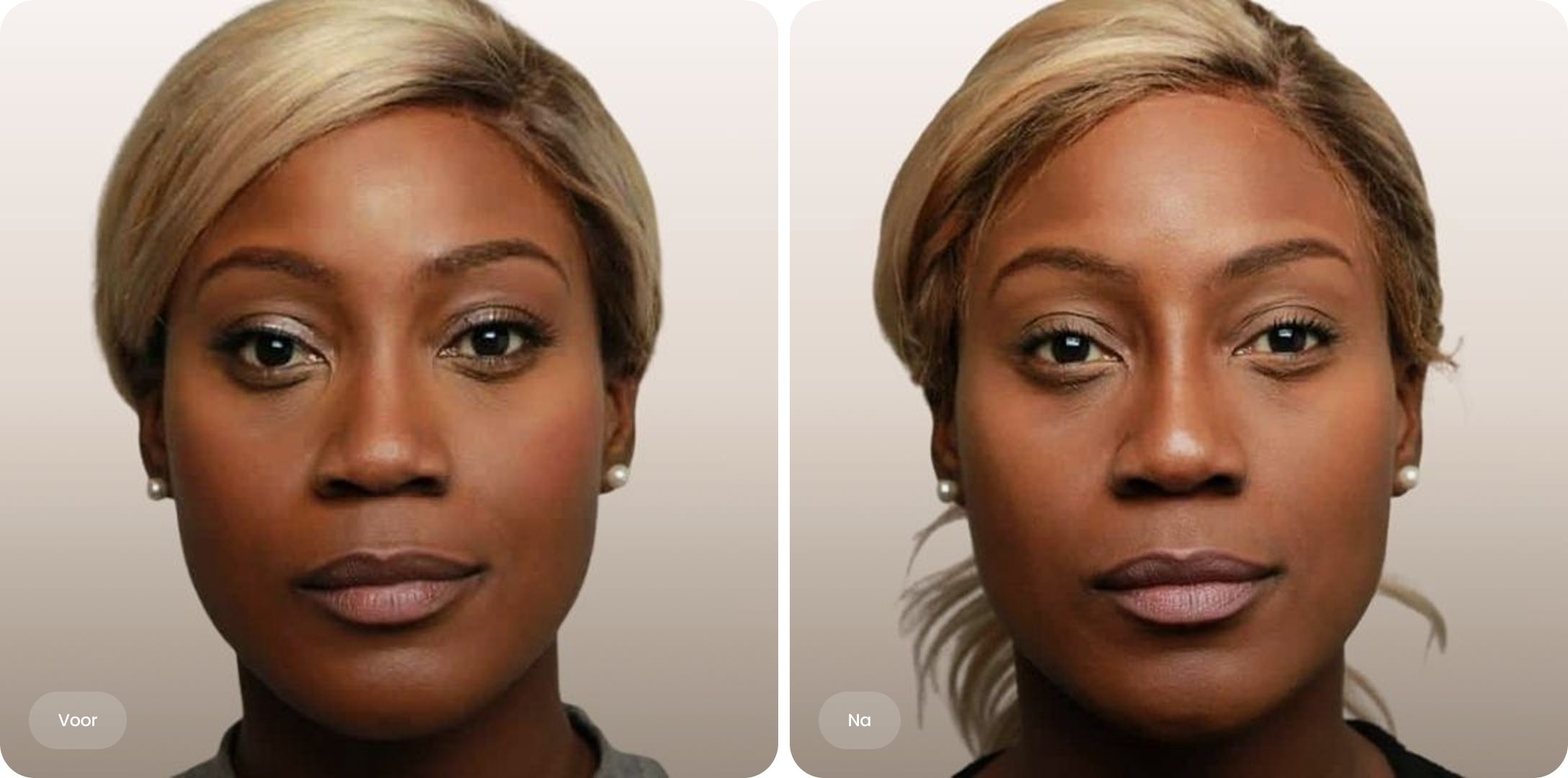 Voor-en-na foto van neuscorrectie met filler bij The Body Clinic