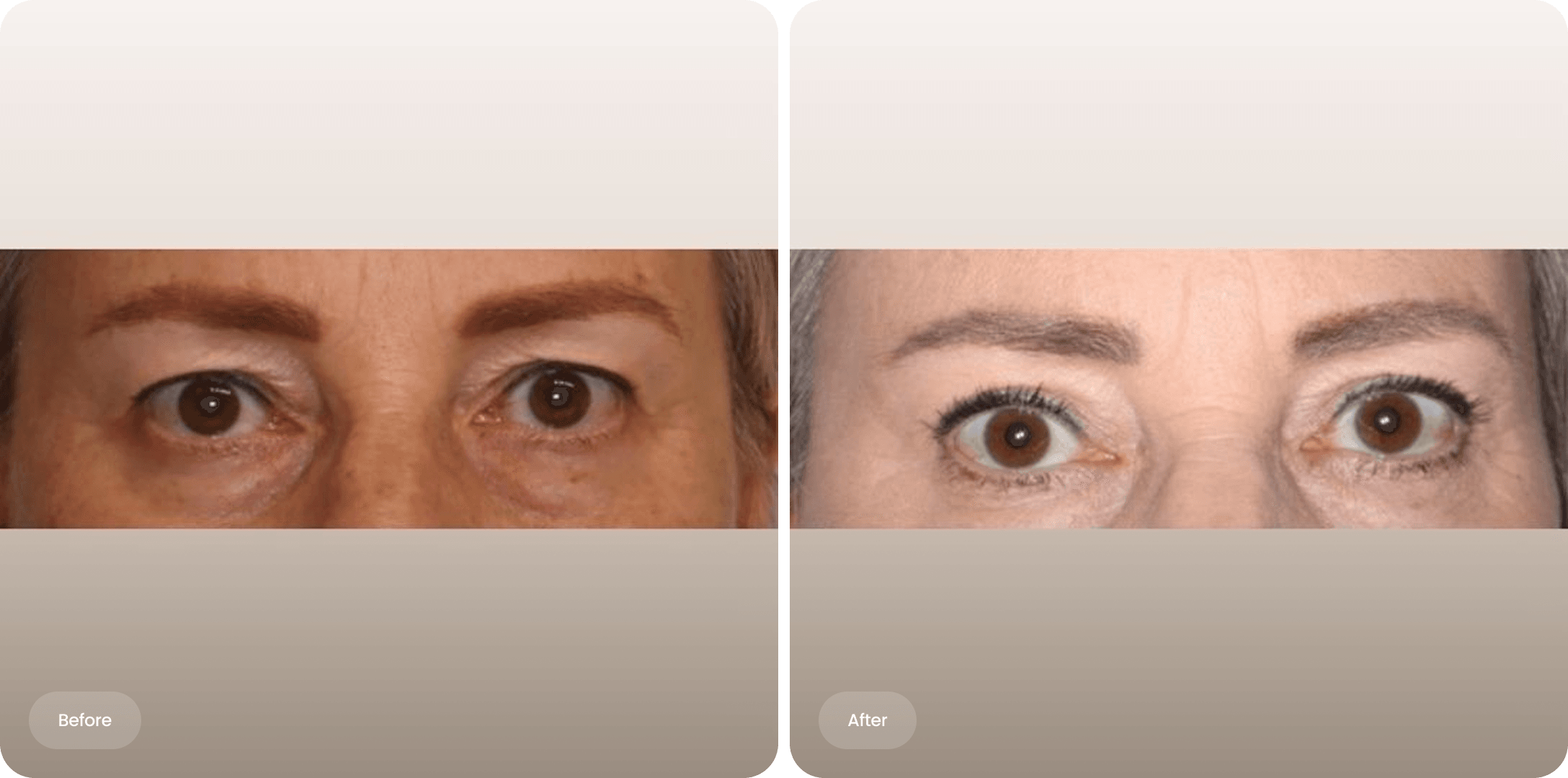 Before and after photo of an upper eyelid correction at The Body Clinic