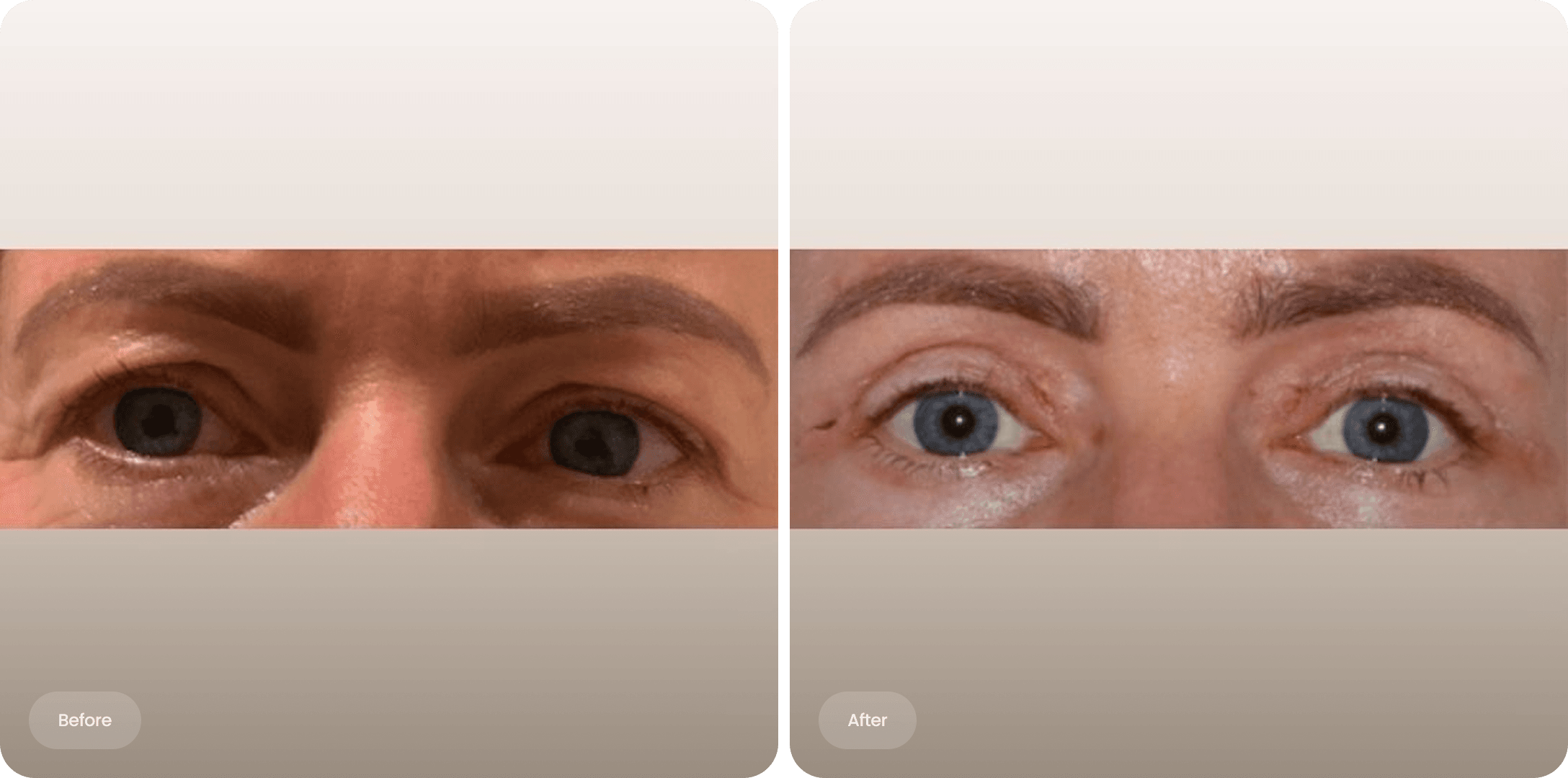 Before and after photo of an upper eyelid correction at The Body Clinic