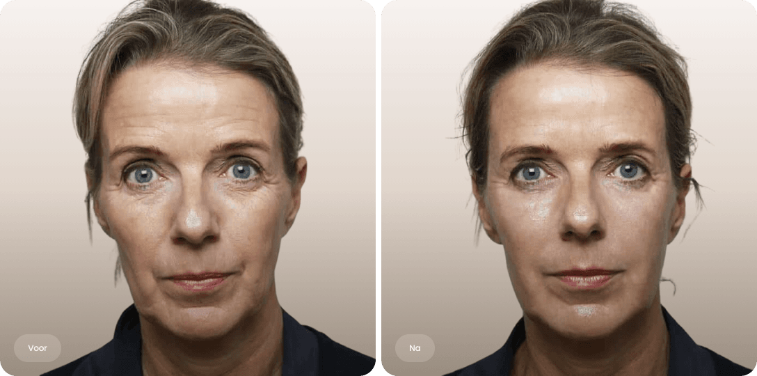 Voor en na foto van liquid facelift met fillers voor verfijnde gezichtscontouren bij The Body Clinic