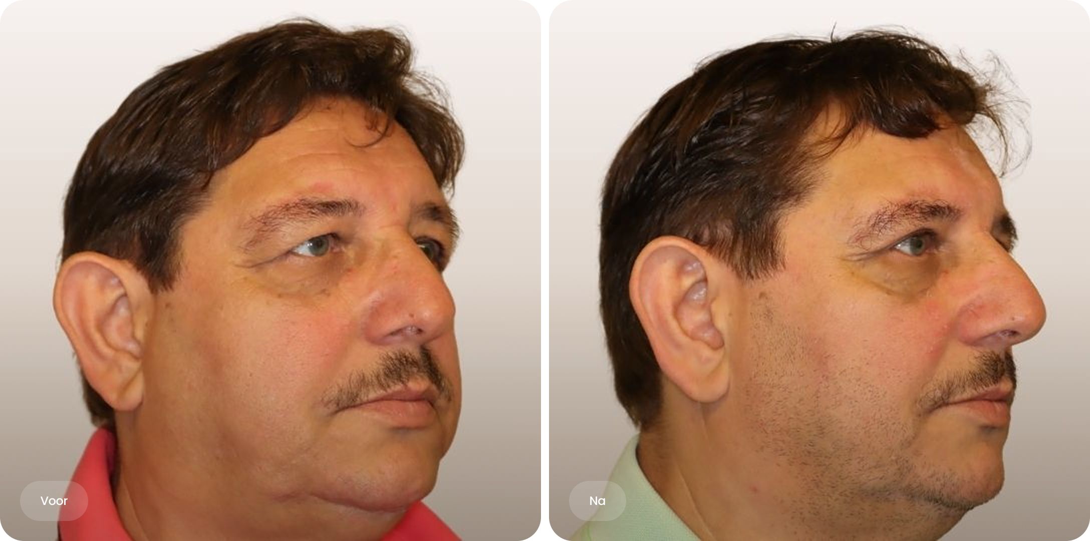 Voor-en-na foto van ooglidcorrectie vanuit driekwart aanzicht bij The Body Clinic