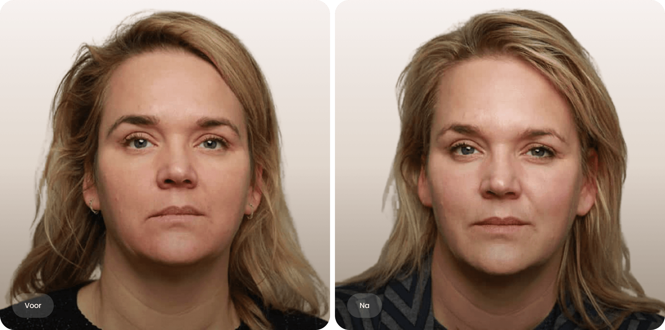 Voor en na foto van fillerbehandeling kaaklijn voor een gedefinieerde kaak bij The Body Clinic