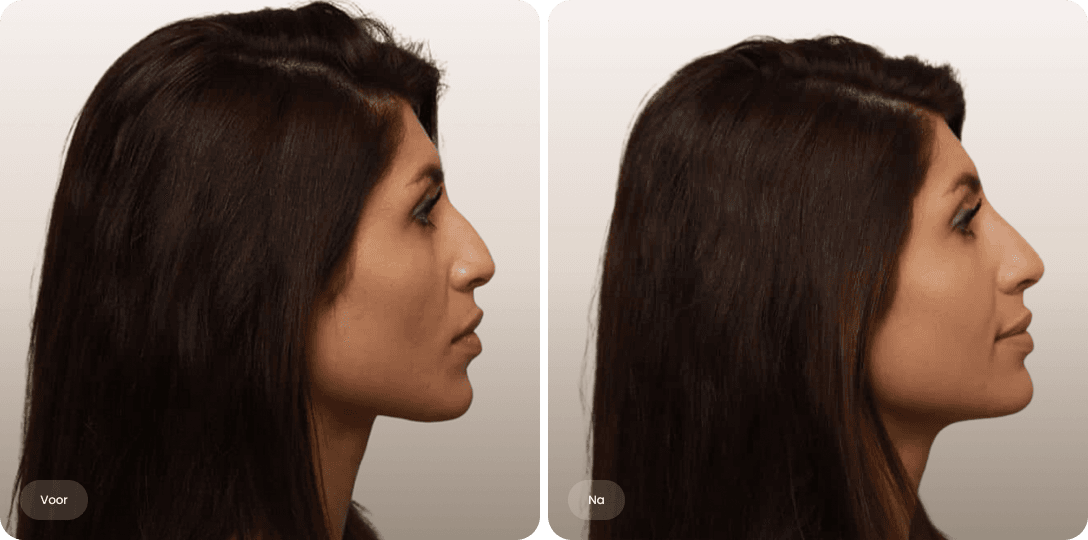 Voor en na foto van neuscorrectie met filler voor een rechter neusprofiel bij The Body Clinic