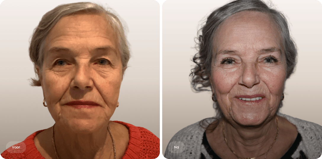 Voor en na foto van bovenooglidcorrectie bij een vrouw voor een alerte uitstraling en frissere oogpartij bij The Body Clinic