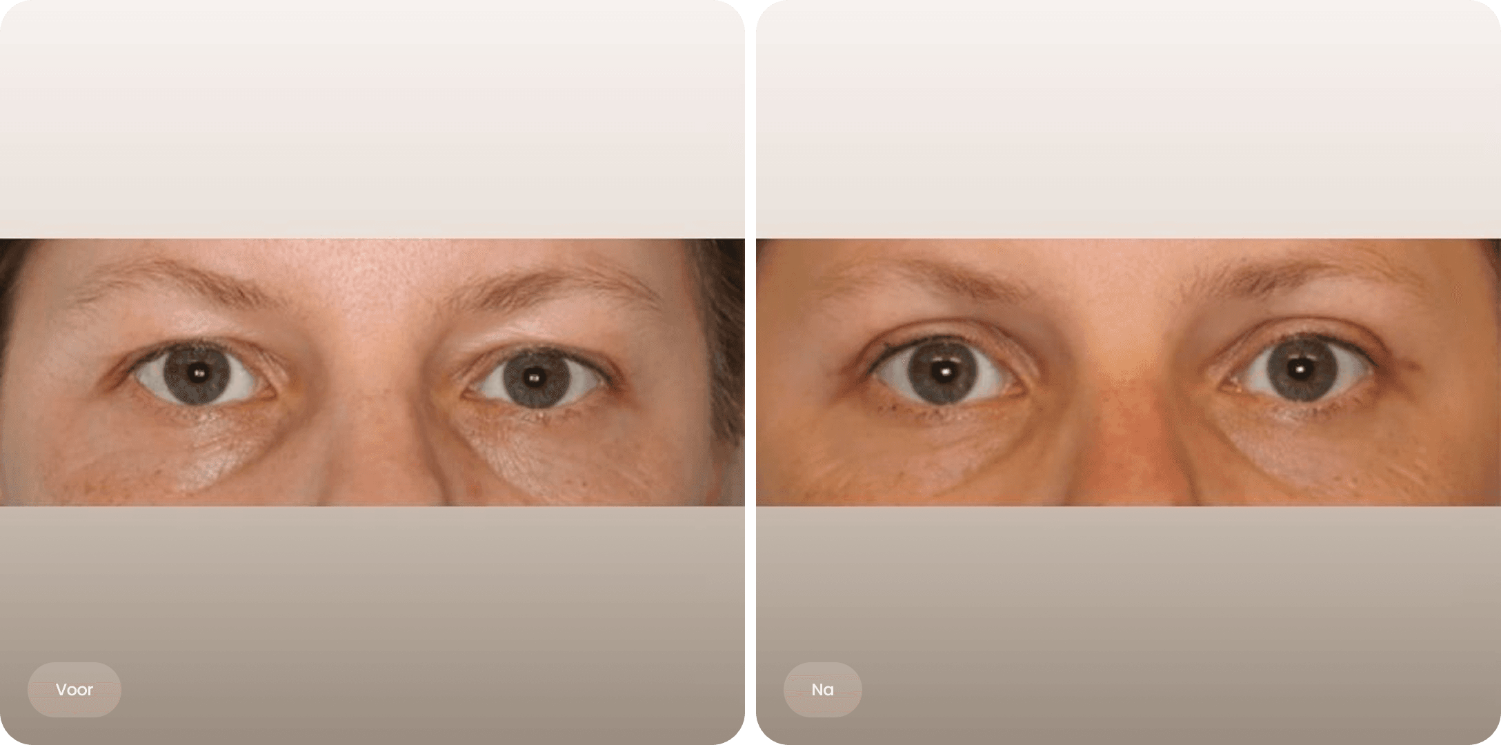 Voor en na foto van een bovenooglidcorrectie bij The Body Clinic