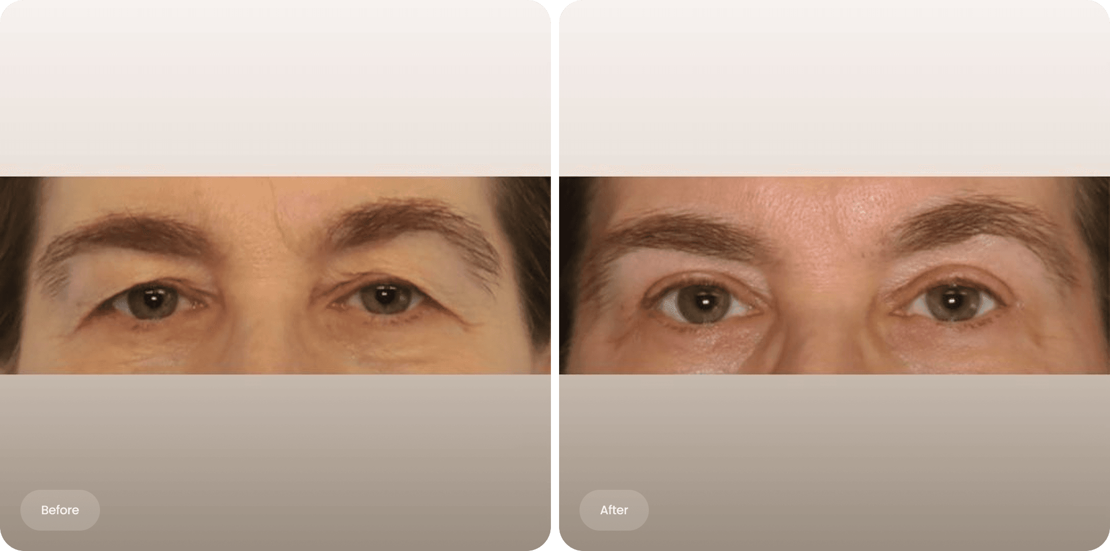 Before and after photo of an upper eyelid correction at The Body Clinic