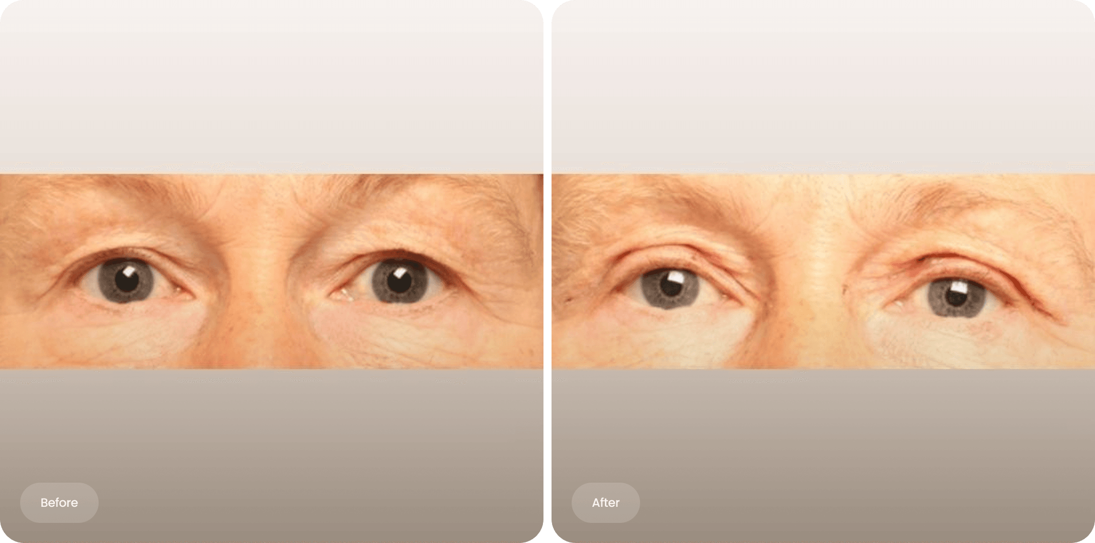 Close-up of eyes Before and after photo of an upper eyelid correction at The Body Clinic and after eyelid lift surgery, showing improved openness.