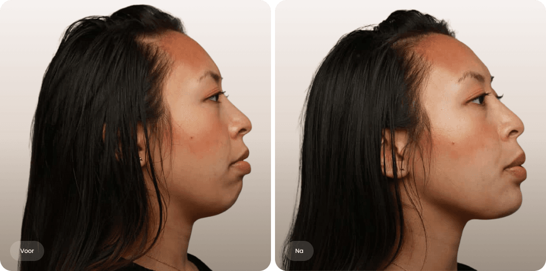 Voor en na foto van fillerbehandeling kin voor meer projectie en een evenwichtiger profiel bij The Body Clinic