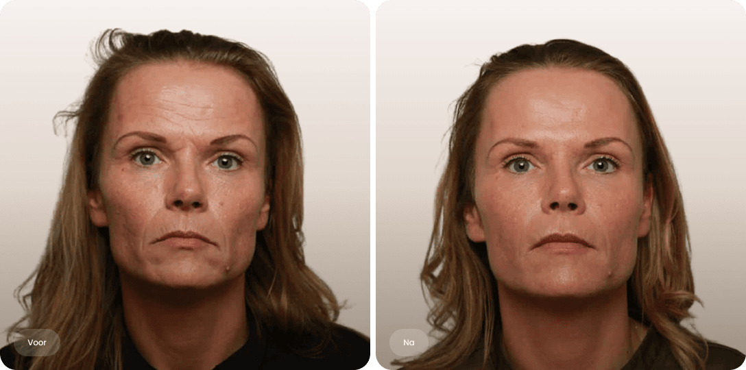 Voor en na foto van liquid facelift met fillers voor een natuurlijk verfrist gezicht bij The Body Clinic