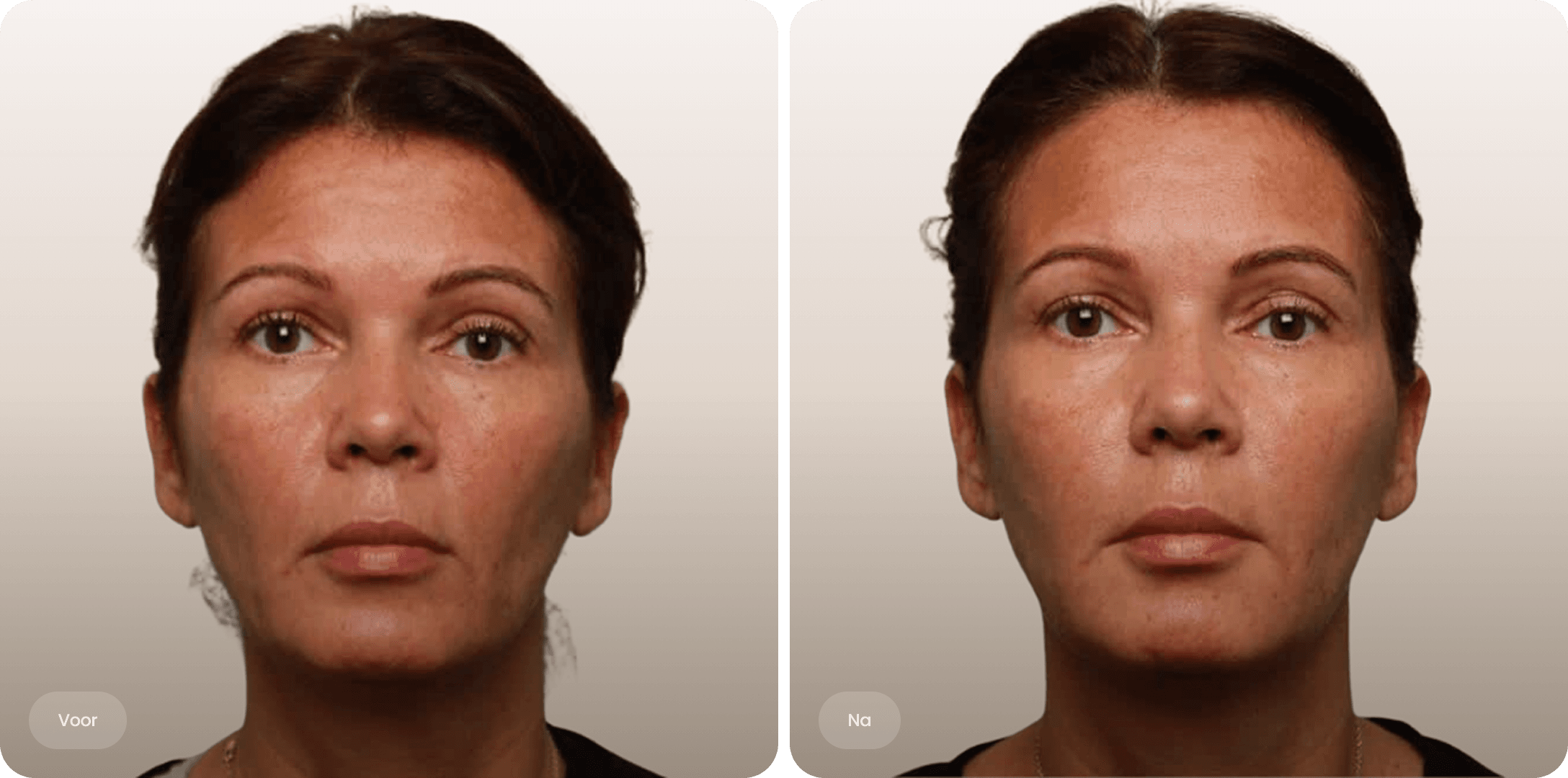 Frontal before and after comparison of a woman with a more refined and refreshed facial appearance.