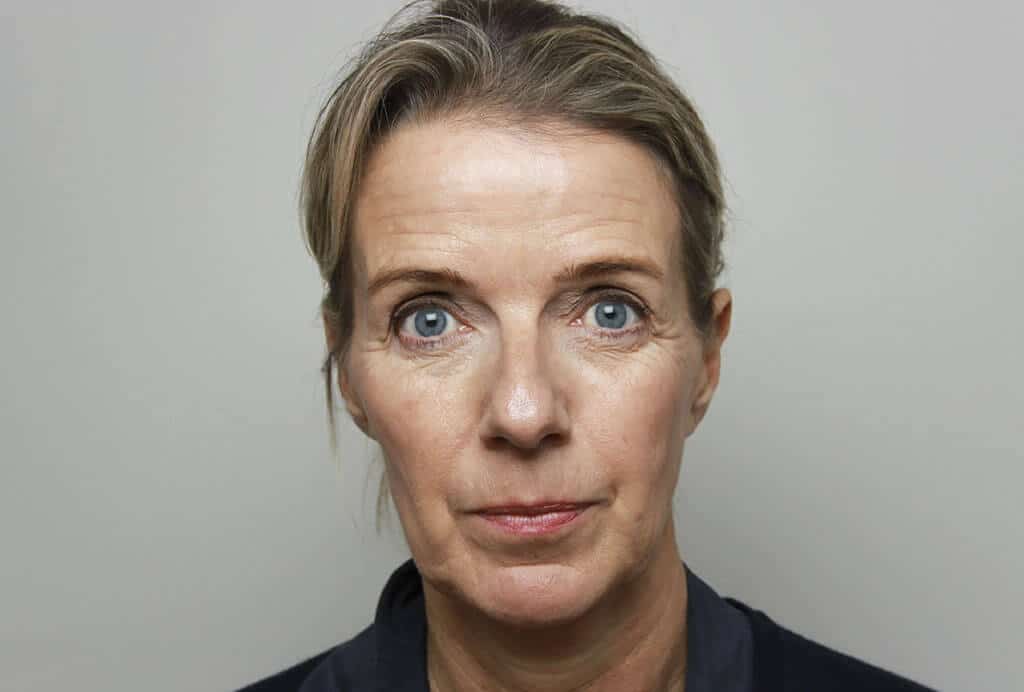 voor foto liquid facelift vrouw