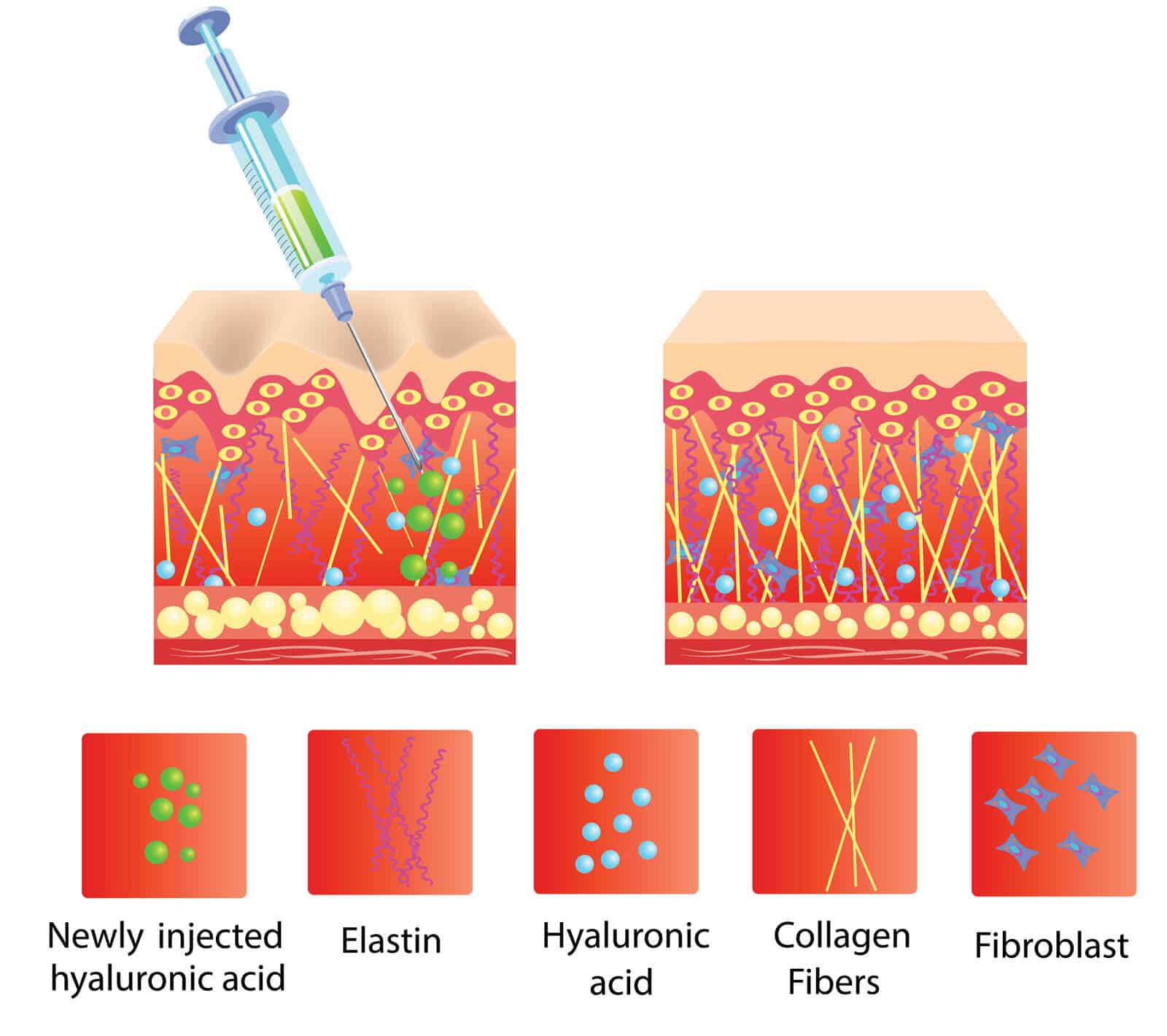 hyaluronic acid injection action