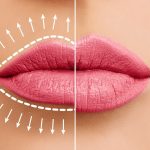 22body clinic lip fillers22